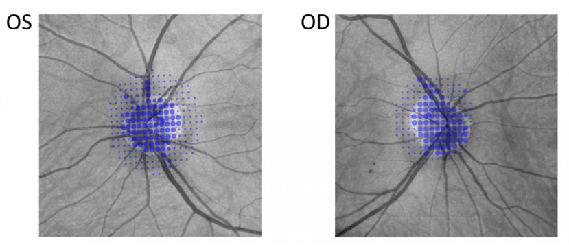 Example of lesion-customized grids placed on the physiological blind spots of a normally-sighted person. VVP is precise enough to measure individual blood vessels leaving the optic nerve head.